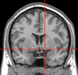 Substantia innominata MRI.PNG