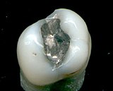 Premolar tooth with amalgam filling Amalgam.jpg