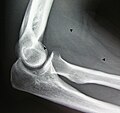 Röntgenaufnahme eines intermuskulären Lipoms im Bereich der Armbeuge. Der scharf umgrenzte, durch Pfeile gekennzeichnete, (kontrastschwache) Bereich markiert das Lipom im anterioren proximalen Unterarm.[13]