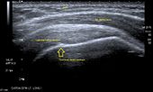 Продольная ультрасонография сухожилия надостной мышцы