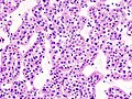 Micrograph of a renal oncocytoma. H&E stain.