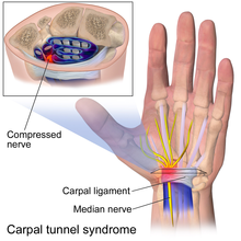 Symptoms of carpal tunnel syndrome and anatomical location of the affected region.