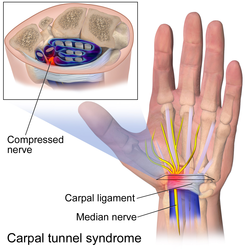 Carpal tunnel syndrome.