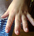 Dermatite herpétiforme – Vésicules et gonflement dans les doigts, aussi commun dans les pieds
