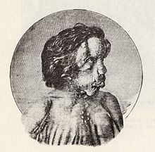 Kresba (v profilu) mužského torza a hlavy postižené těžkými deformace.