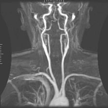 Magnetic resonance angiography Mra1.jpg