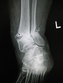 Bone fracture - Wikipedia