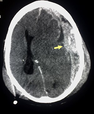 Trauma subdural arrow.jpg