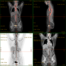 Severe vasculitis of the major vessels, displayed on FDG-PET/CT Vasculitis FDG PET-CT.png