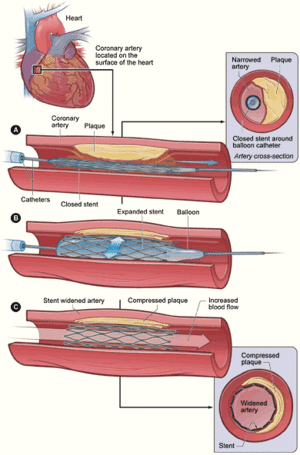 Diagram of coronary angioplasty and stent plac...