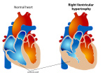 Miniatura para Hipertrofia ventricular