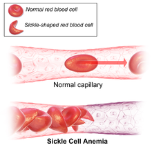 Sickle cell anemia is an adaptation against malaria. Sickle Cell Anemia.png