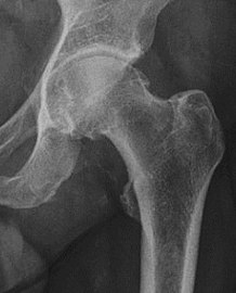 X-ray in pincer impingement type of hip dysplasia