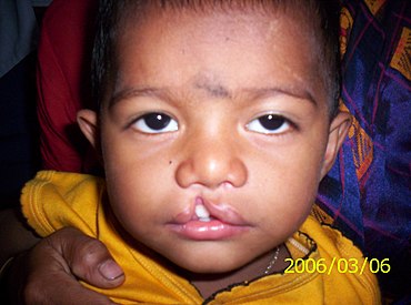 http://upload.wikimedia.org/wikipedia/commons/thumb/3/3a/Cleft_lip_child.jpg/370px-Cleft_lip_child.jpg