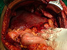 After resection of left lobe liver tumor Liver..JPG