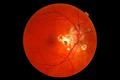Presumed ocular 
</hi>
 lasmosis syndrome- 11192007. png