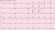 Miniatura para Ritmo idioventricular acelerado