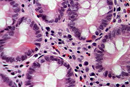Complete intestinal metaplasia in a case of chronic gastritis, HE 3