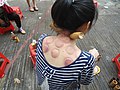 A woman receiving fire cupping in China.