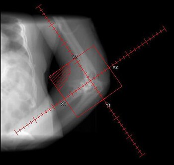 Elbow Heterotopic Ossification Radiation Thera...