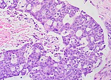 Serous carcinoma of ovary Serous carcinoma (3061775966).jpg