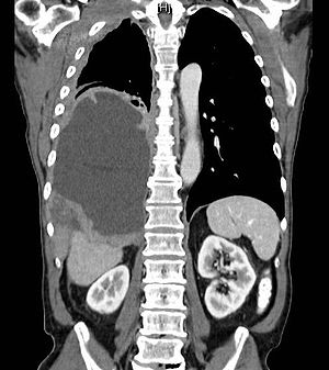 Malignant Mesothelioma, CT scan coronal