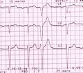 Premature ventricular complexes or Extrasystoles