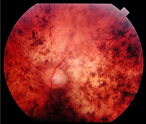 Fundus of a patient with cone rod dystrophy.png