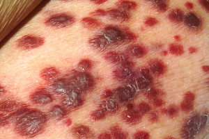 ضایعات پوستی یک مبتلا به ایدز ،این ضایعات پوستی نشان دهنده کاپوسی سارکوما هستند