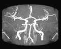 Circulus arteriosus (imago resonantiae magneticae - sequentia angiografica) proiectione anteriori