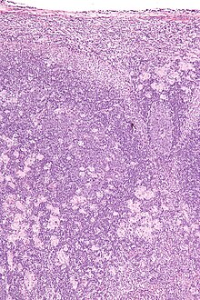 Micrograph of a lymph node showing the characteristic changes of toxoplasmosis (scattered epithelioid histiocytes (pale cells), monocytoid cells (top-center of image), large germinal centers (left of image)) H&E stain Toxoplasmosis lymphadenopathy - intermed mag.jpg