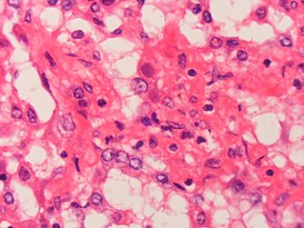 Adenovirus infection Case 161 (5443939520).jpg