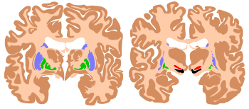 Components of the basal ganglia, shown in two cross-sections of the human brain. Blue: caudate nucleus and putamen. Green: globus pallidus. Red: subthalamic nucleus. Black: substantia nigra. Basal ganglia.svg