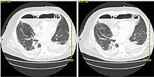 CT scan of a patient with Descending Necrotizing Mediastinitis. CT scan of a patient with Descending Necrotizing Mediastinitis.jpg