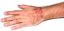 Cerkáriová dermatitida vyvolaná druhem Trichobilharzia szidati