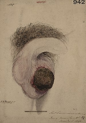 Рисуване на чифт тестиси под петна от срамната коса и частично нарисуван пенис. Тъмнокафява бучка на по-големия тестис е заобиколена от червено възпаление.