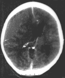 CT scan showing epidural hematoma, a type of traumatic brain injury (upper left) Epidural hematoma.png