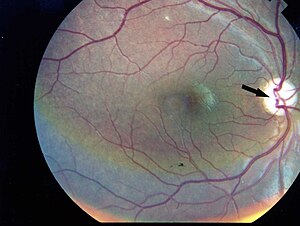Фотографско изображение на дясното око на пациента, показващо оптична атрофия без диабетна ретинопатия синдром на Wolfram.jpg