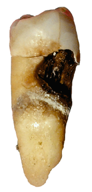 http://upload.wikimedia.org/wikipedia/commons/thumb/3/3e/Toothdecay.png/190px-Toothdecay.png