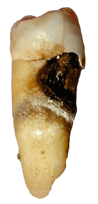 Cervical decay on a premolar
