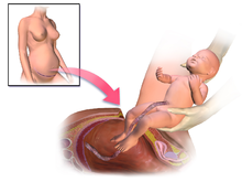 Illustration depicting caesarean section Blausen 0223 CesareanDelivery.png