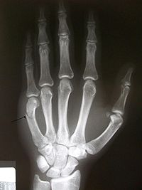 Boxers fracture