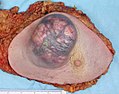 Mastectomy specimen containing a very large invasive ductal carcinoma of the breast. To the right, the nipple can be seen on the pink skin, while in the center of the picture a large blue and pink swelling or tumor can be seen. Blood stained fat tissue is seen at the cut margins.