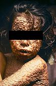 File:Child with Smallpox Bangladesheyesblacked.jpg