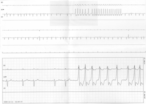 English: Non-sustained run of ventricular tach...