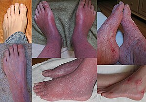 Синдром красной (жгучей) кожи - Feet Collage.jpg