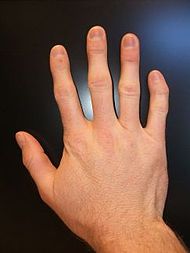 Clinodactyly - a curved pinky is often seen in the hands of people who have autism!