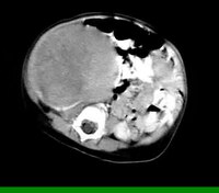 Файл: Wilms Tumor CTScan.ogv