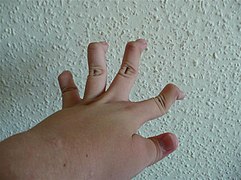 Людина з СЕД, що показує гіпермобільні пальці, включаючи мальформацію "лебедина шия" на 2-й 5-й фалангах, і гіпер-мобільні пальці