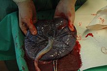 Placenta held.jpg